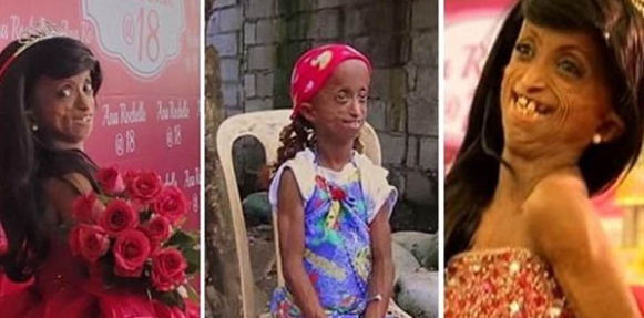 مرض نادر يحول فتاة إلى سيدة عجوز