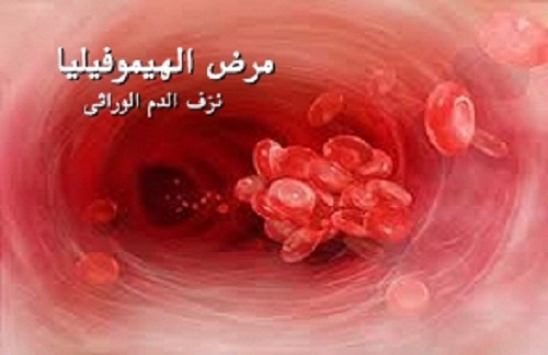 في اليوم العالمي للهيموفيليا .. بناء دعم أسري ومجتمعي في السابع عشر من نيسان نزف الدم