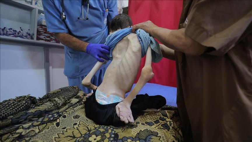 غزة.. ارتفاع وفيات التجويع الإسرائيلي إلى 162 فلسطينيا بينهم 92 طفلا