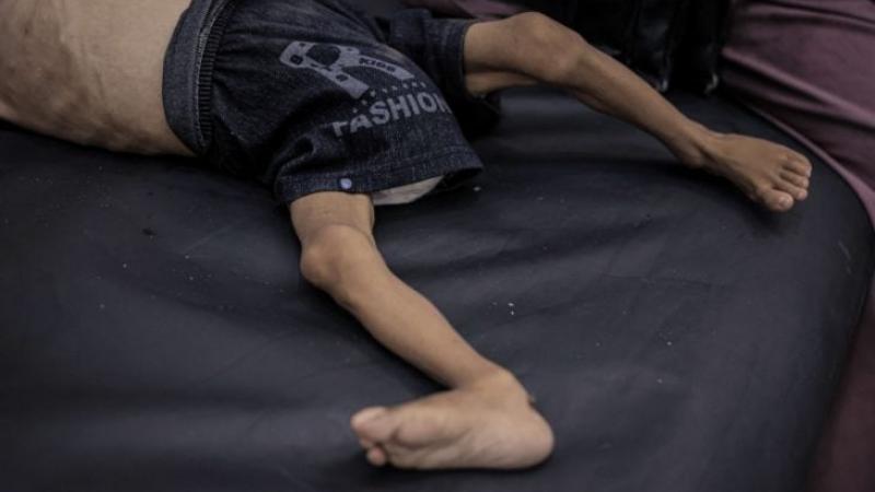غزة: 95 إصابة بمتلازمة غيلان باريه النادرة وتحذير من "انتشار مقلق وسريع"