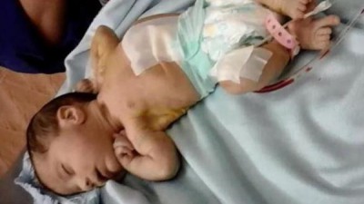 في حالة نادرة..جنين داخل رضيعة عمرها 13 يوما