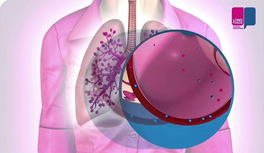 ما هو الالتهاب الرئوي وهل يهدد فعلاً حياة المصابين به؟ التهاب الرئة