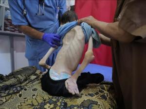 غزة.. ارتفاع وفيات التجويع الإسرائيلي إلى 162 فلسطينيا بينهم 92 طفلا