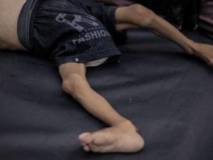 غزة: 95 إصابة بمتلازمة غيلان باريه النادرة وتحذير من "انتشار مقلق وسريع"