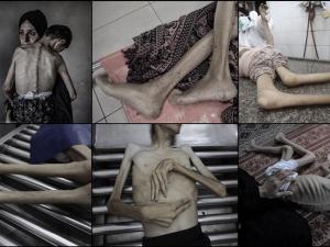 التجويع الإسرائيلي يقتل 13 فلسطينيا بينهم 3 أطفال في 24 ساعة