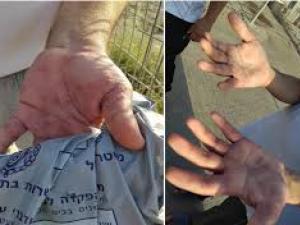 مرض الجرب يتفشى في سجني النقب وعوفر وسط استمرار جرائم الاحتلال بحق الأسرى