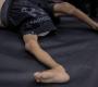 غزة: 95 إصابة بمتلازمة غيلان باريه النادرة وتحذير من "انتشار مقلق وسريع"